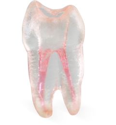 Endo 3DP™#12 Accessed Pre-Molar (UL4)