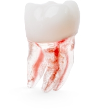 X2 Endo™#30 Molar (LR6)